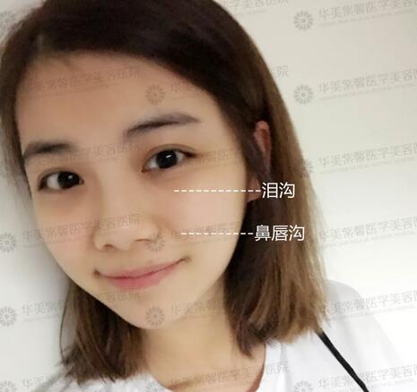 乔雅登多少钱已不是事儿|玻尿酸全场买一赠一，抓紧啦！