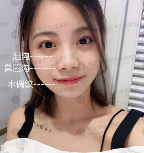 乔雅登多少钱已不是事儿|玻尿酸全场买一赠一，抓紧啦！