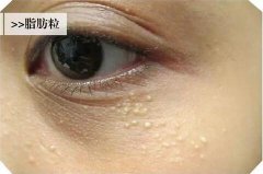 汗管瘤的调节方法有哪些安？我查到了这些资料~ width=