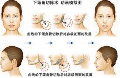 女士肥胖下颌角整形的恢复保养问题! width=
