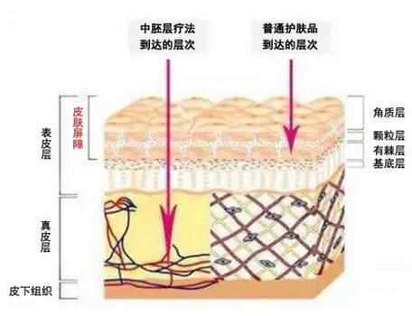 给头皮“打针”的*********疗法，果真的有那么神吗？