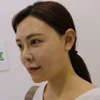 赵博士整形美容医院做隆鼻手术擅长吗?真人案例果图分享