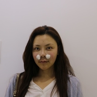 赵博士整形美容医院做隆鼻手术擅长吗?真人案例果图分享