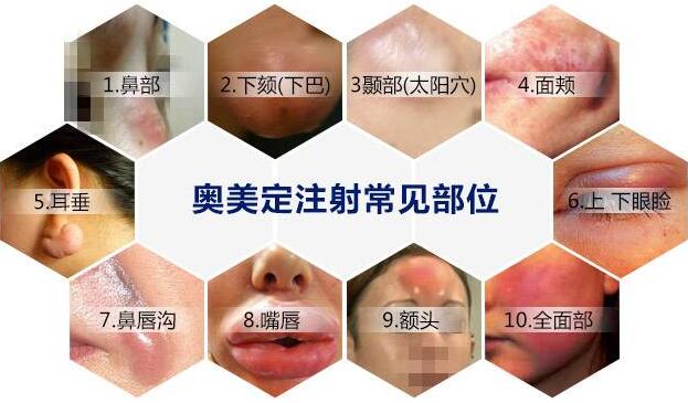 奥美定取出价格大致在哪个范围内?很想知道~