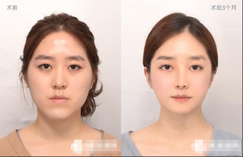 韩国双鄂手术费用大概多少？技术好吗？