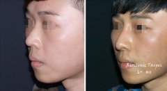 男士隆鼻——谁说爱美只是女士的权利~ width=