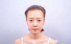 招风耳面相好不好？如何改良？术后如何护理？ width=