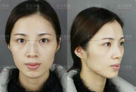双眼皮宽度6mm恢复后是怎样的果，来看小怡的逆袭！