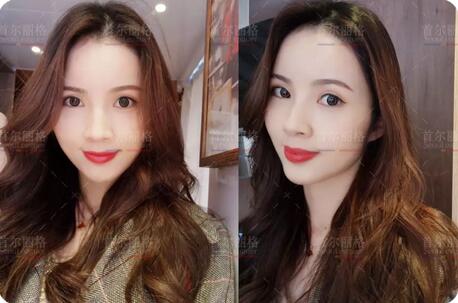 双眼皮宽度6mm恢复后是怎样的果，来看小怡的逆袭！