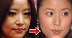 中医去眼袋是为了不动刀子的果断选择，巴适! width=