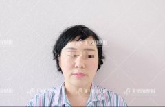 自体脂肪填充专用营养acmetea艾苛蜜是什么玩意儿呢？ width=
