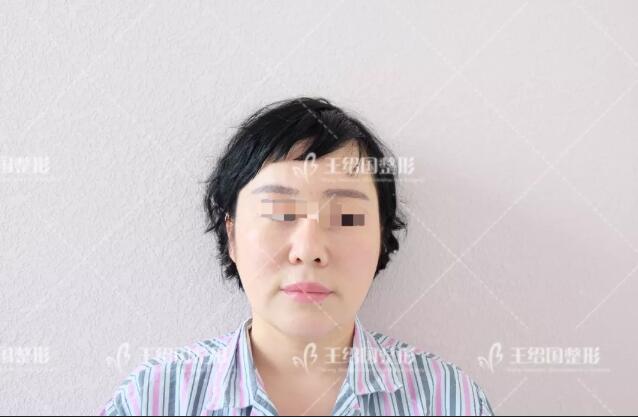 自体脂肪填充专用营养acmetea艾苛蜜案例一则，很巴适！
