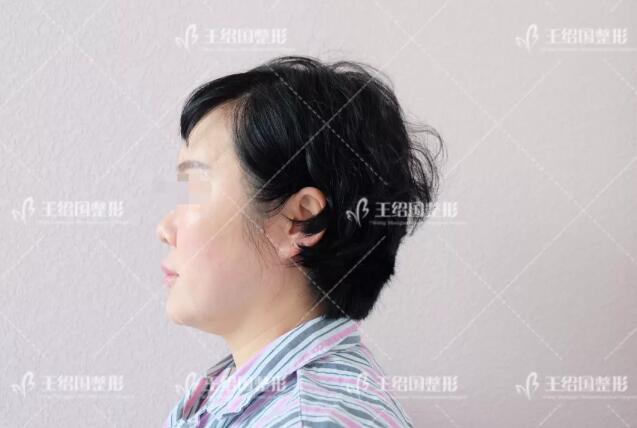 自体脂肪填充专用营养acmetea艾苛蜜案例一则，很巴适！