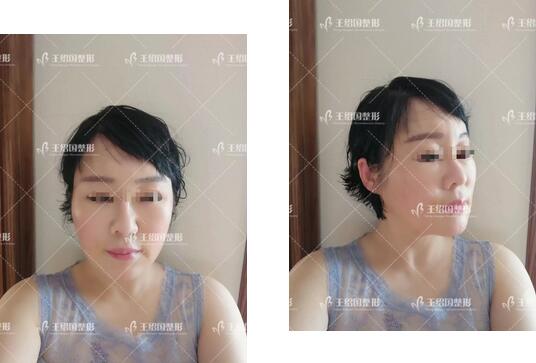 自体脂肪填充专用营养acmetea艾苛蜜案例一则，很巴适！