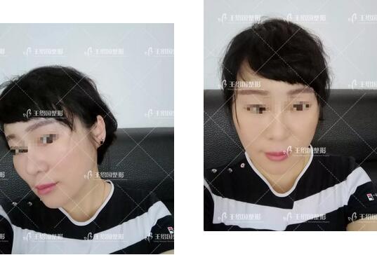 自体脂肪填充专用营养acmetea艾苛蜜案例一则，很巴适！