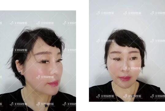 自体脂肪填充专用营养acmetea艾苛蜜案例一则，很巴适！