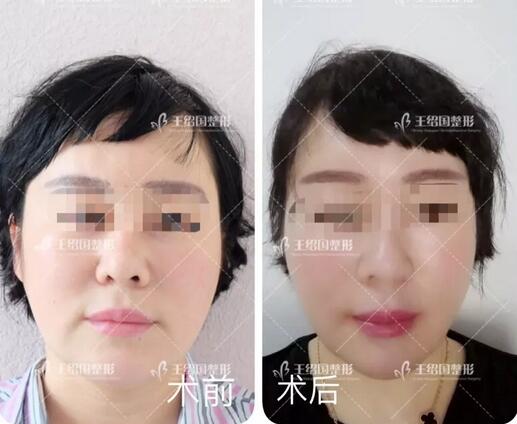 自体脂肪填充专用营养acmetea艾苛蜜案例一则，很巴适！
