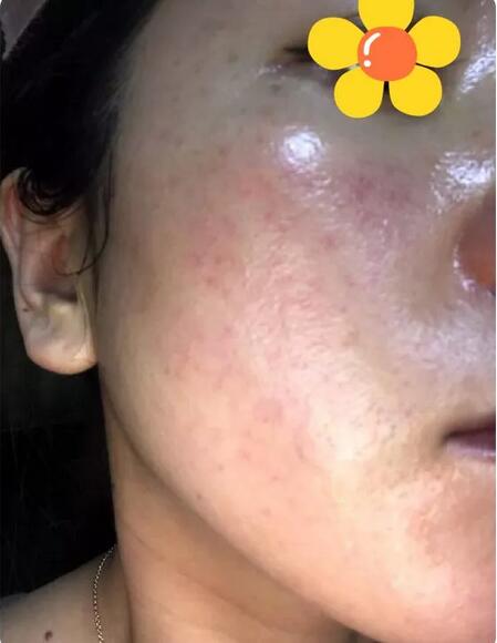 AAPE注射抗衰15天竟然嫩到“换张脸”，细纹、毛孔统统滚蛋~