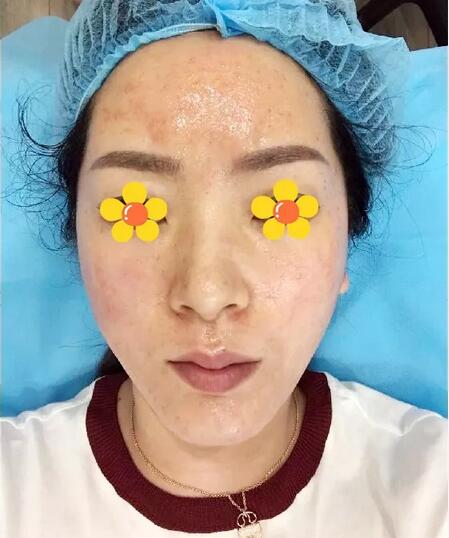 AAPE注射抗衰15天竟然嫩到“换张脸”，细纹、毛孔统统滚蛋~