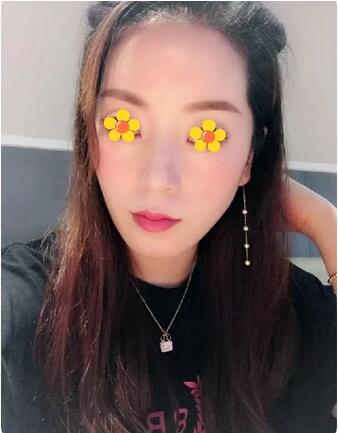 AAPE注射抗衰15天竟然嫩到“换张脸”，细纹、毛孔统统滚蛋~