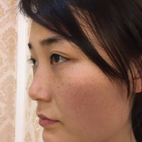 庄璐医生技术如何?庄璐医生整形案例曝光