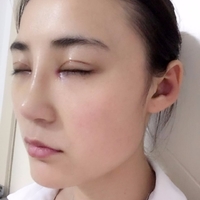 庄璐医生技术如何?庄璐医生整形案例曝光