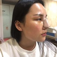 沈阳杏林整形医院价格表【内附隆鼻真实案例及果图】