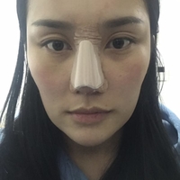 沈阳杏林整形医院价格表【内附隆鼻真实案例及果图】