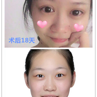 郑州东方整形医院做双眼皮怎么样?贺洁院长真实案例为你解答