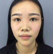 刘冬青蒜头鼻整形前后对比，这么丑的蒜头鼻不适合小仙女~ width=