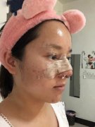 北京玉之光唐振利隆鼻案例，唐振利做的鼻子就是好看~ width=