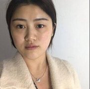 【陈兵医生案例贴】陈兵医生做的双眼皮自然的不像话，就和天生的一样~ width=