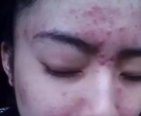 微针美塑去痘坑