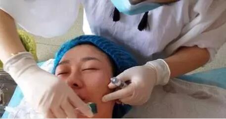 微针美塑去痘坑