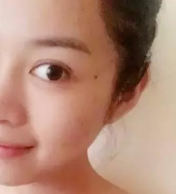 微针美塑去痘坑