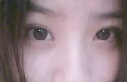 微针美塑去痘坑