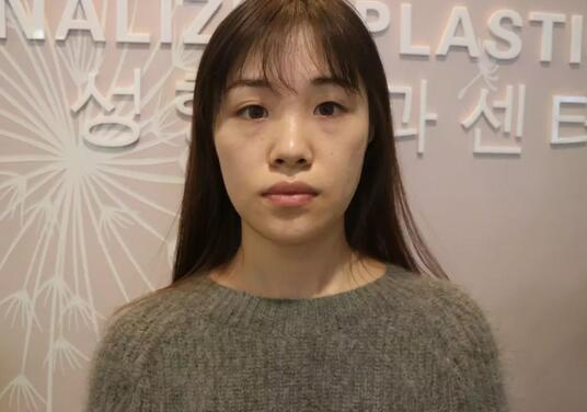 青岛诺德整形医院分段式假体隆鼻真实案例分享~