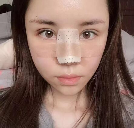 青岛诺德整形医院分段式假体隆鼻真实案例分享~