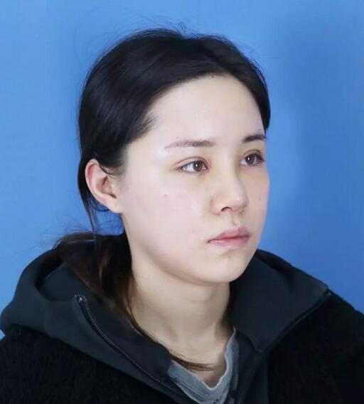 青岛诺德整形医院分段式假体隆鼻真实案例分享~