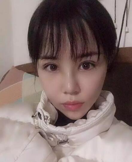 青岛诺德整形医院分段式假体隆鼻真实案例分享~