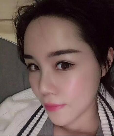 青岛诺德整形医院分段式假体隆鼻真实案例分享~