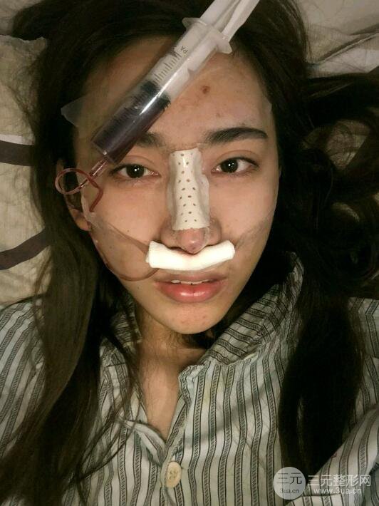 巫文云隆鼻修复案例：我的悲痛人生从此结束！