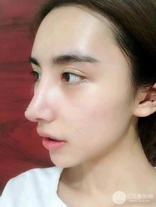 巫文云隆鼻修复案例：我的悲痛人生从此结束！