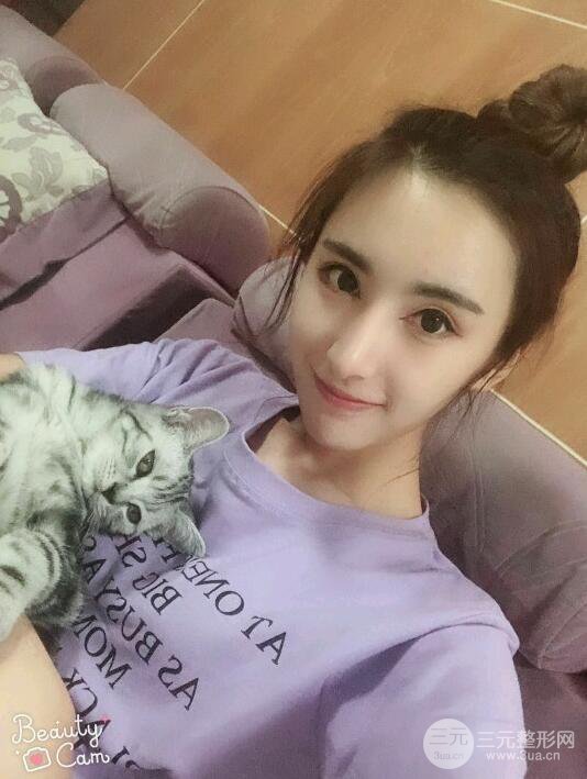 巫文云隆鼻修复案例：我的悲痛人生从此结束！