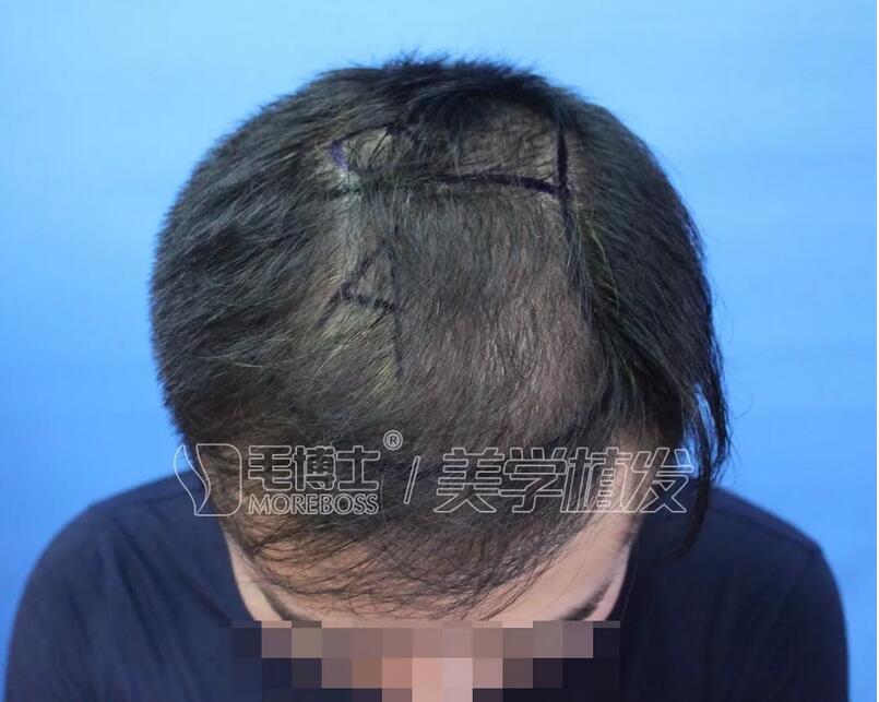 植信植发正规吗|植信植发10个月的陈先森给你讲！