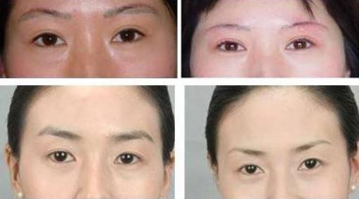 去鱼尾纹专家找谁呢?来遇美社咨询就对了