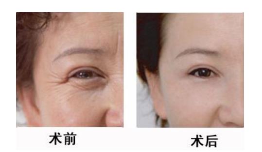 彩光除皱再也不用厚厚的粉底来遮掩，卸下“面具”依旧彩亮