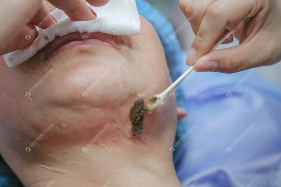 【百嘉丽公益救助】女诗人毁容，第6次调节后，她笑了……