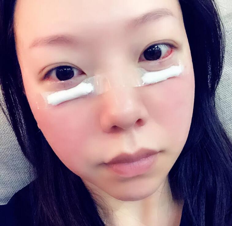 雅皙祛眼袋有吗？真人真事儿可以说明哟！