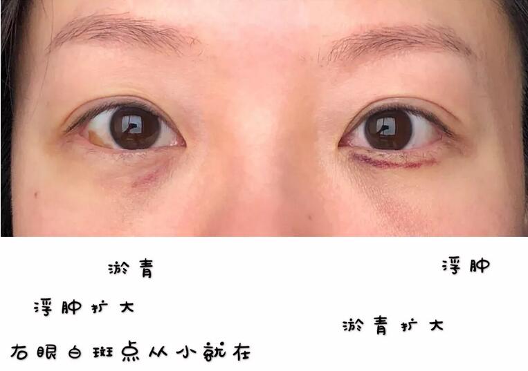 雅皙祛眼袋有吗？真人真事儿可以说明哟！